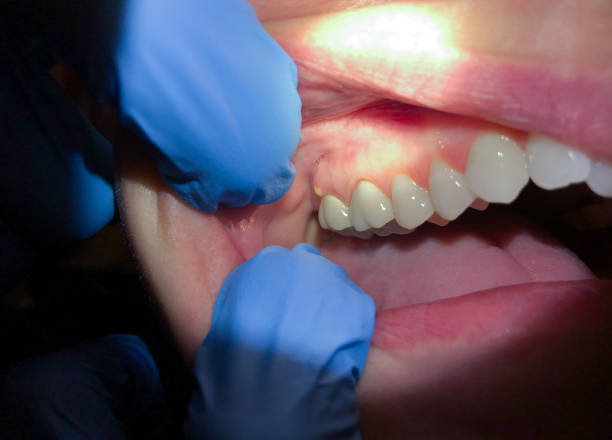 Best Emergency Gum Treatment in Hillsboro, ND